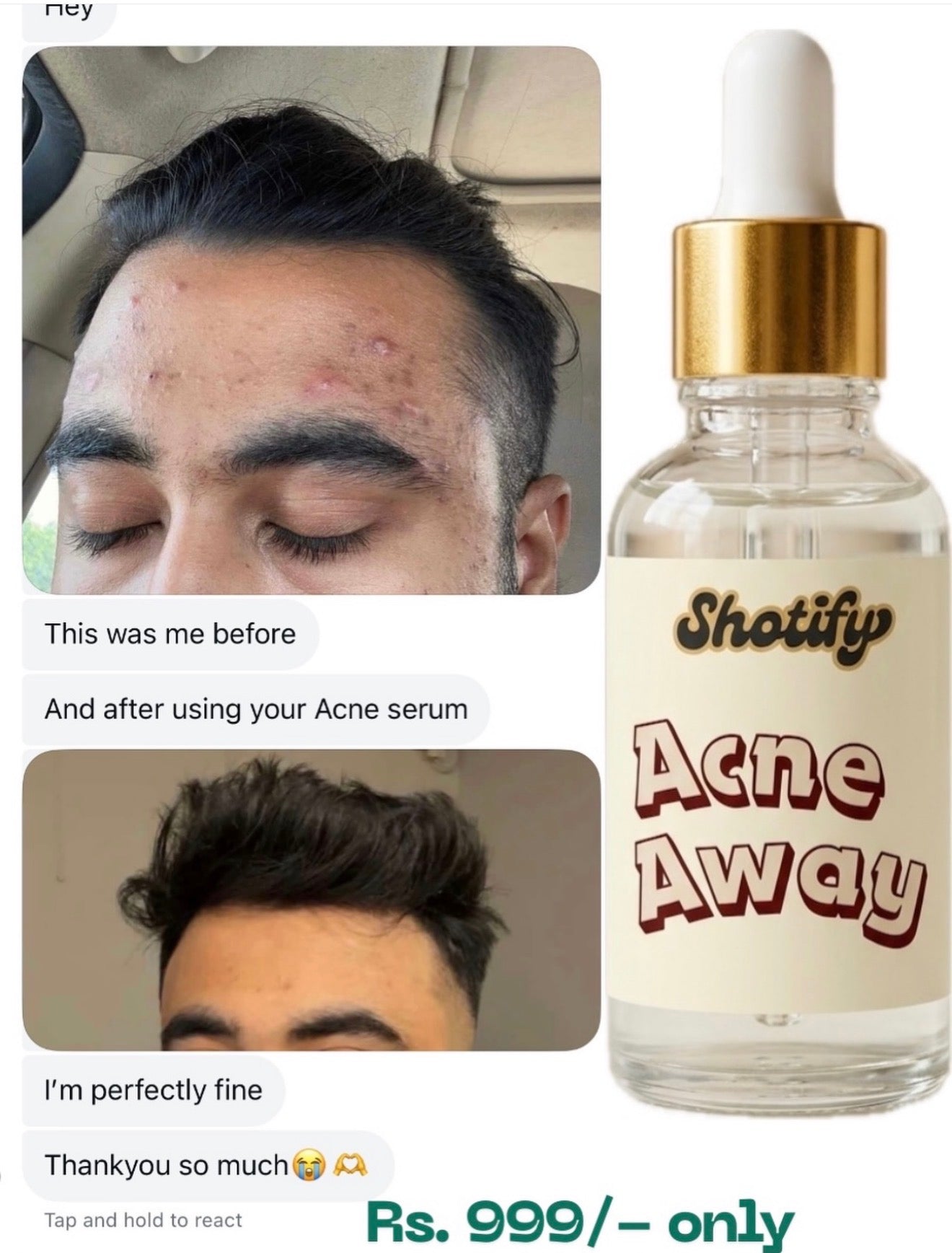 Acne Away Serum by Shotify